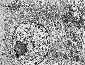 F,24y. | gangliocytoma F,24y. | gangliocytoma
